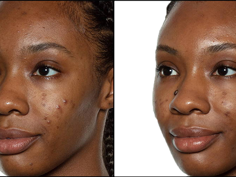 Get rid of acne fast: 12 home remedies - Kenyan Moves