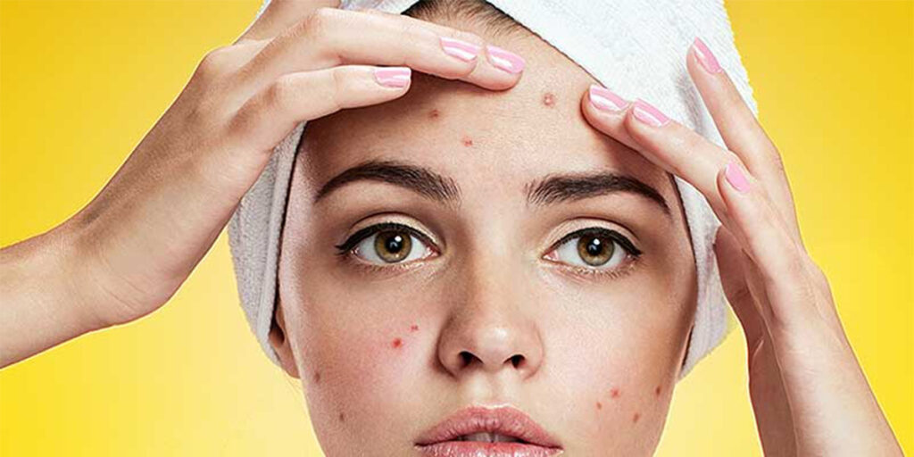 Get rid of pimples