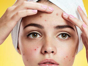 Read more about the article Get rid of pimples fast with these 10 ways
