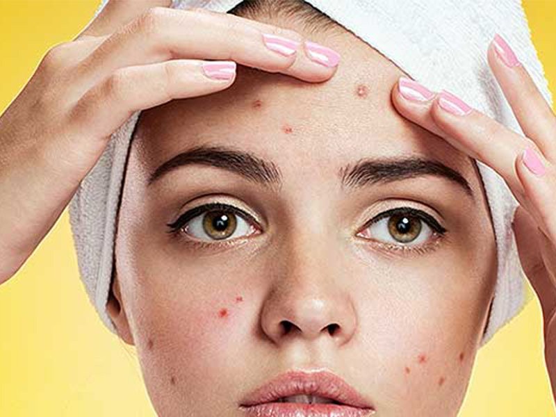 get rid of pimples