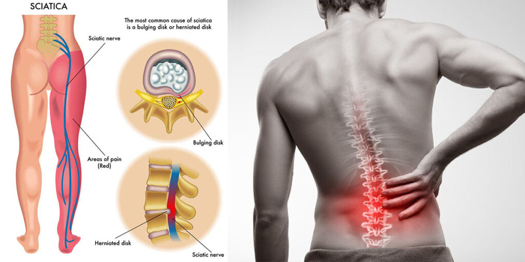 Sciatica condition causes lower back pain