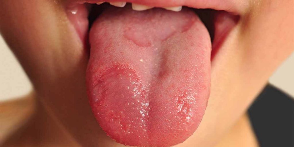 Tongue ulcerations 